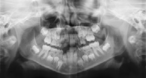 Dental Radiographs (X-Rays) - Pediatric Dentist in Madison, MS