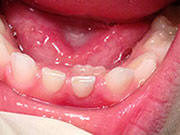 Baby Teeth - Pediatric Dentist in Madison, MS