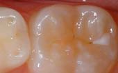 Sealant-Before - Pediatric Dentist in Madison, MS