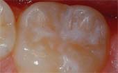 Sealant-After - Pediatric Dentist in Madison, MS